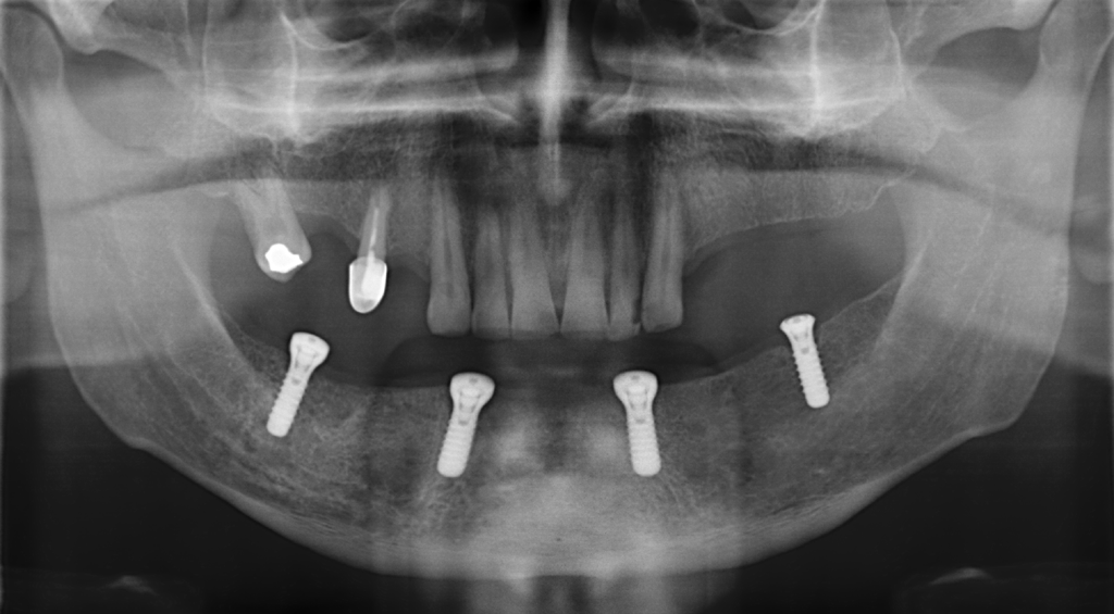 Fig.02 riabilitazione implantare mandibola edentula