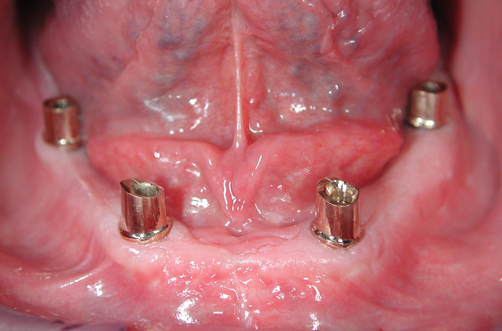 Fig.06 riabilitazione implantare mandibola edentula