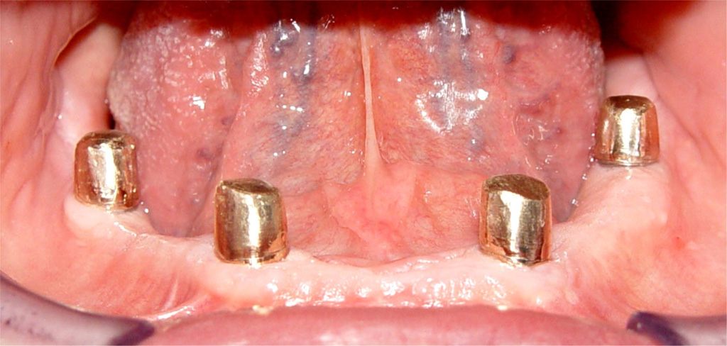 Fig.07 riabilitazione implantare mandibola edentula