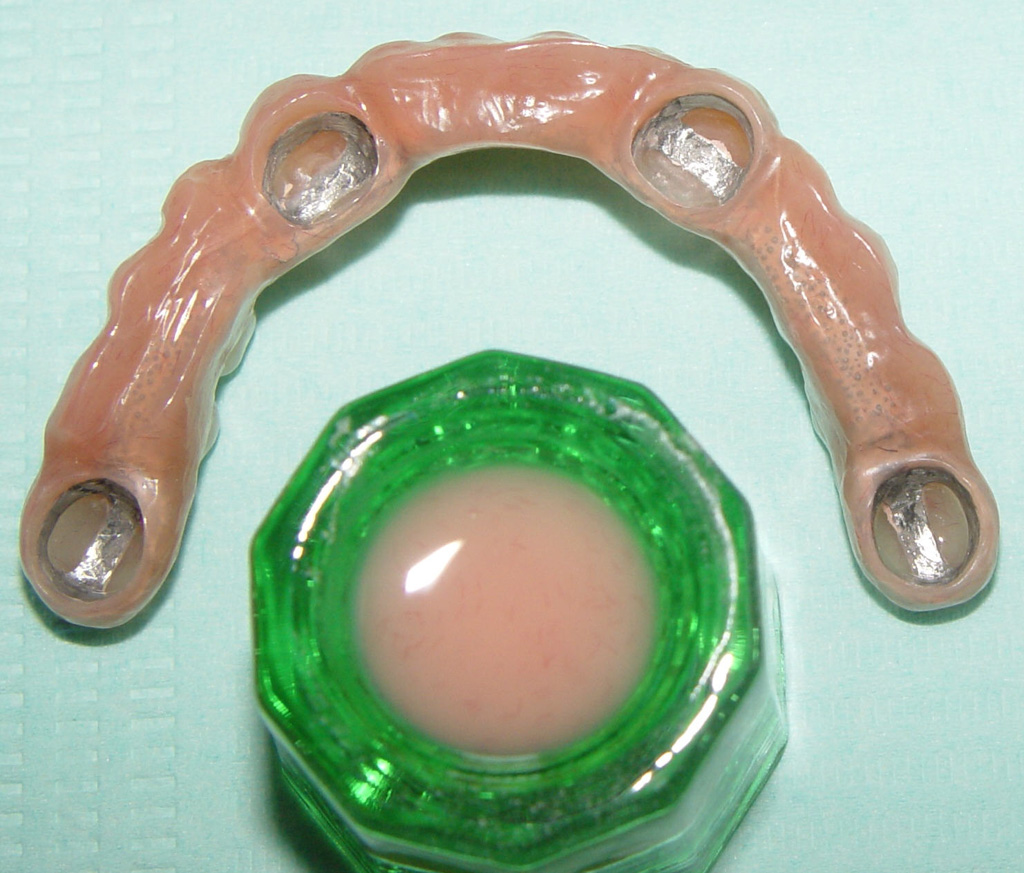 Fig.08 riabilitazione implantare mandibola edentula