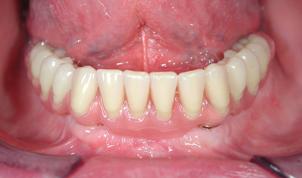 Fig.12 riabilitazione implantare mandibola edentula