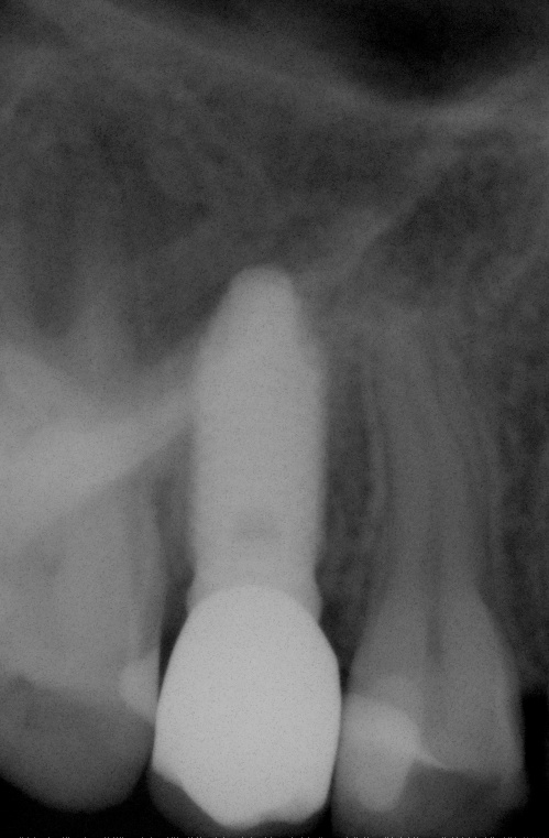 fig2 riabilitazione implantare premolare superiore