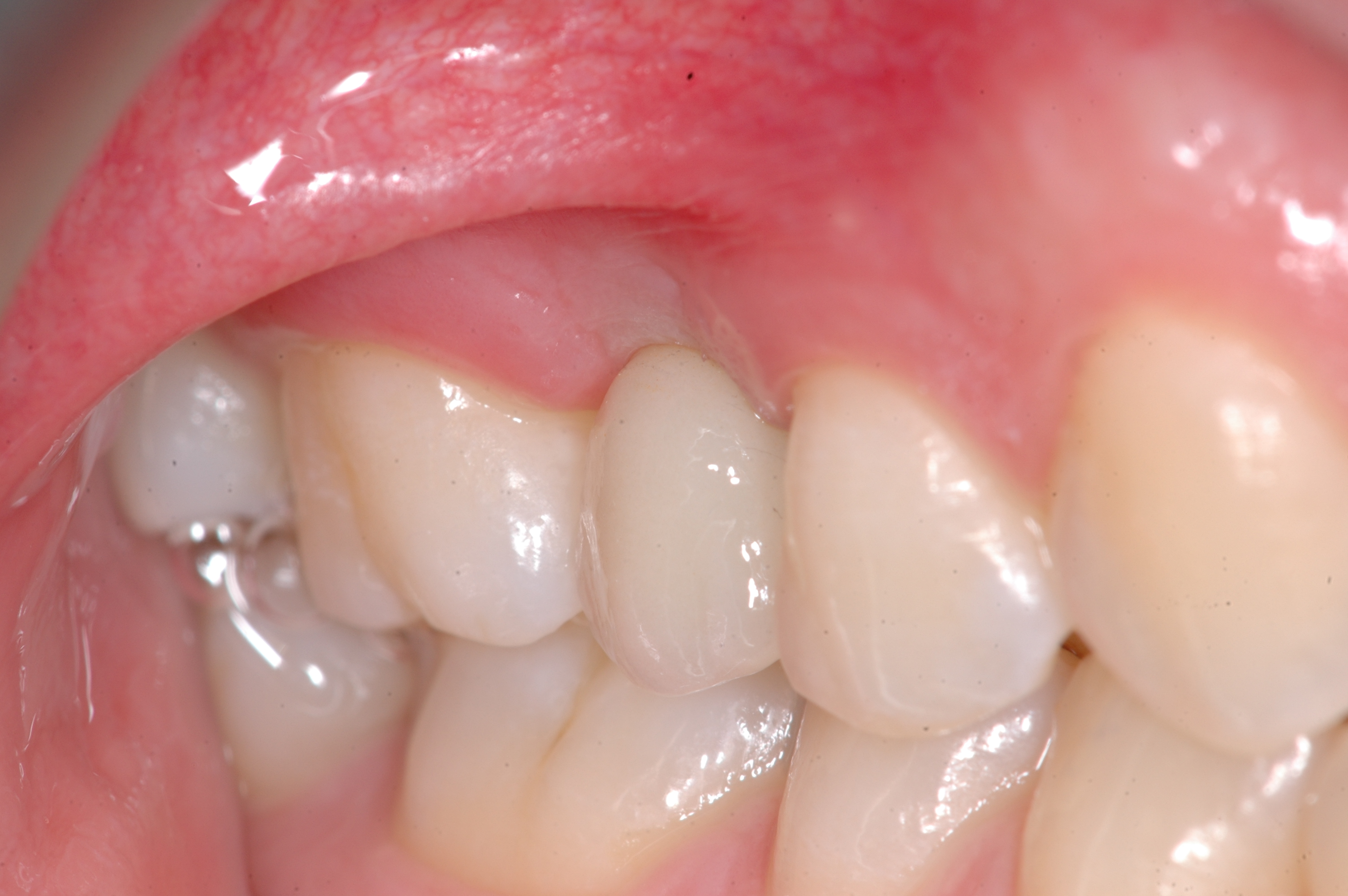 fig4 riabilitazione implantare premolare superiore