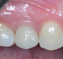 Riabilitazione implantare premolare superiore