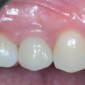 Riabilitazione implantare premolare superiore