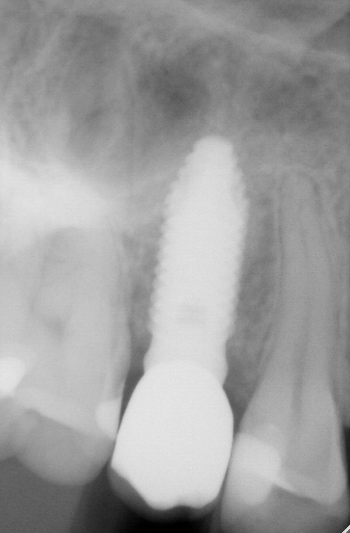 fig7 riabilitazione implantare premolare superiore